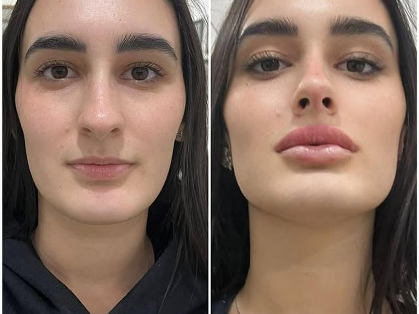 Caso Full Face publicado por Tiago Brasil: fotos reais da paciente antes e depois